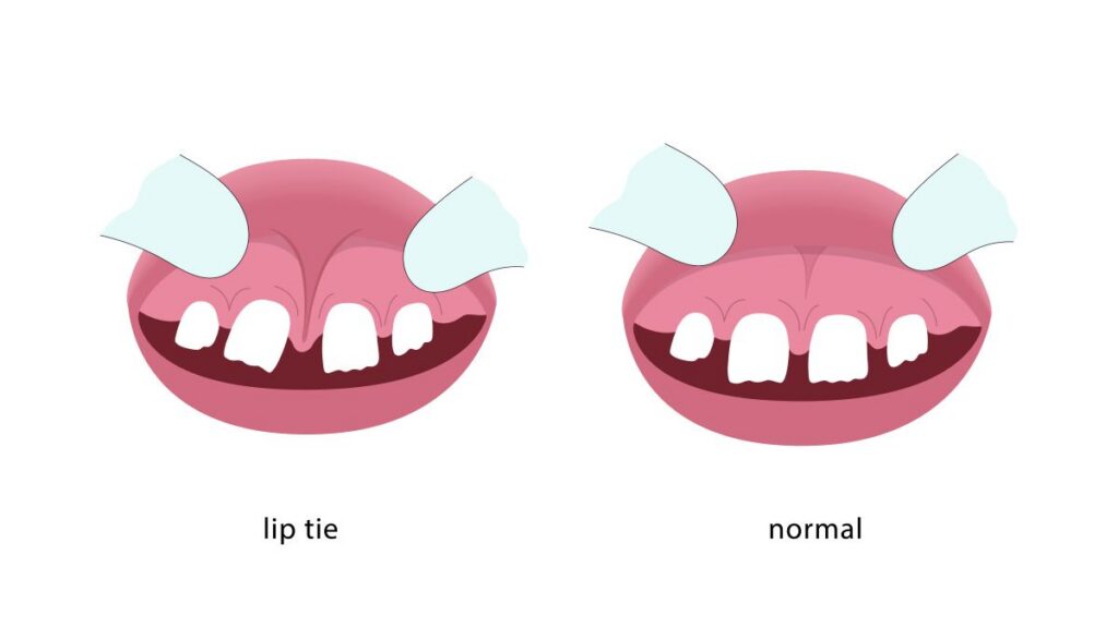 lip tie vs normal graphic