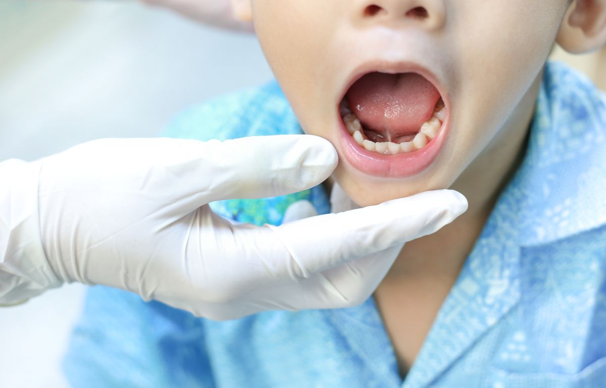 Pediatric dental exam: a gloved hand lifts the child’s lip to reveal the lower teeth for inspection.