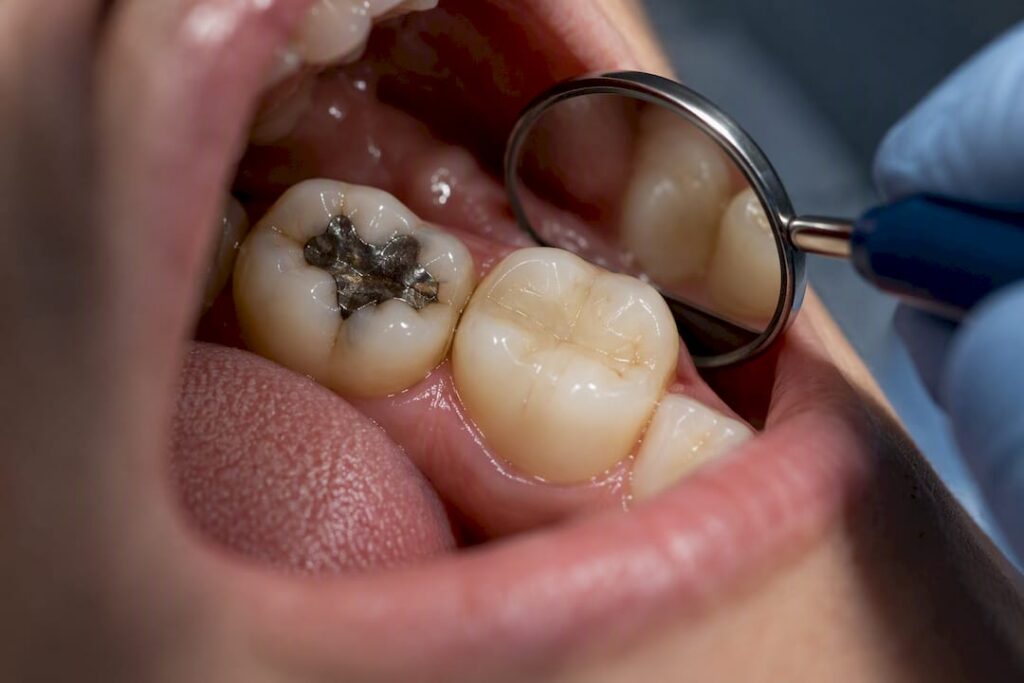 Molar teeth with composite and amalgam restorations