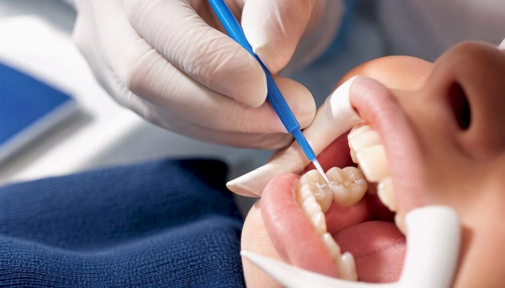 Dentist applying sealant to child molar