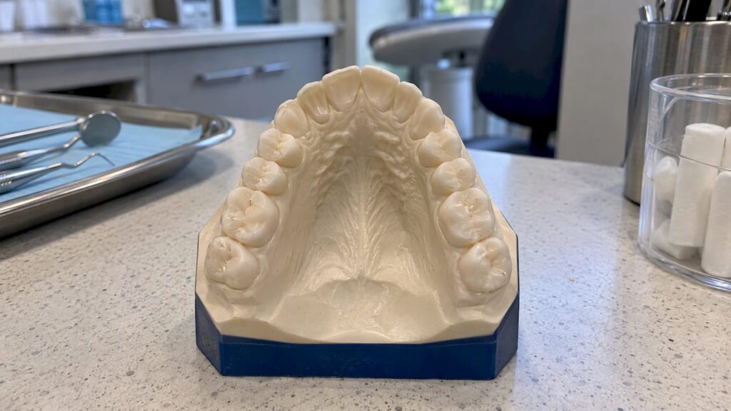 Orthodontic model showing a narrow palate