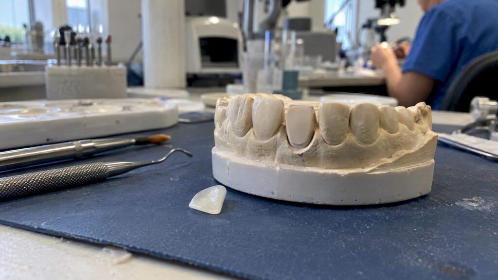 Porcelain veneer beside a dental model